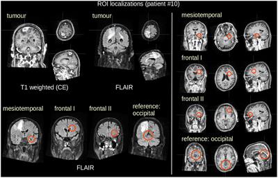 Bevacizumab is associated with cerebral microstructural alterations: a DTI study in high-grade glioma